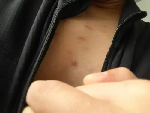 我是健身教练,胸前了些硬疙瘩,不疼不痒,喝酒会变大,是饮食问题吗