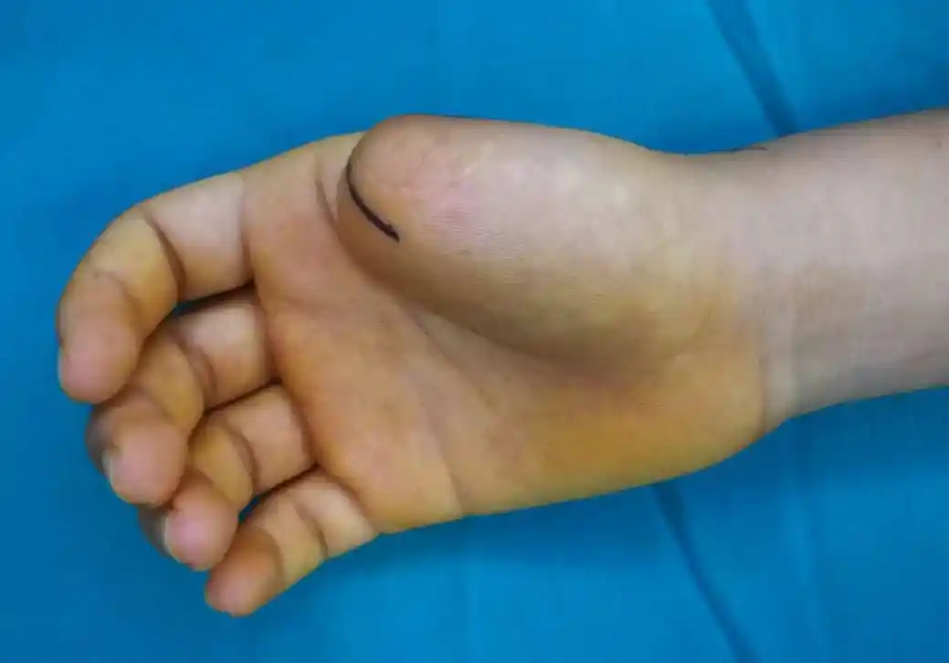 湖南小伙大拇指缺失17年医生用脚趾成功移植