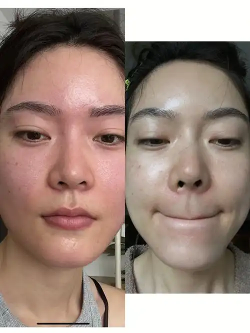 最让我头痛的就是毛孔粗大!