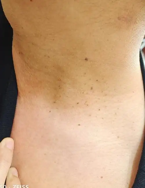 67脖子上的小肉瘤其实是它丝状疣