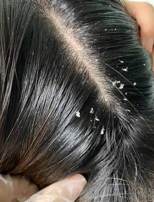 头屑,头油,脱发等问题困扰不少人健康的头皮是什么样子?