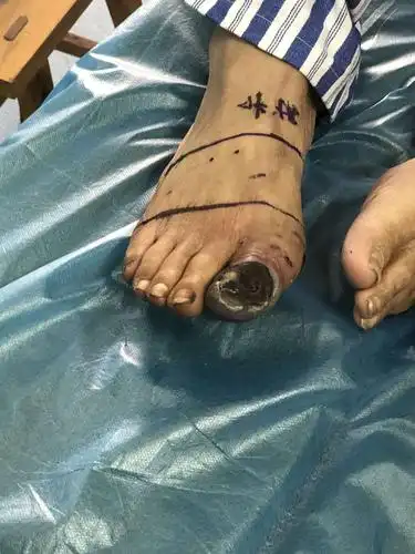 右前足离断术,解除患者痛苦