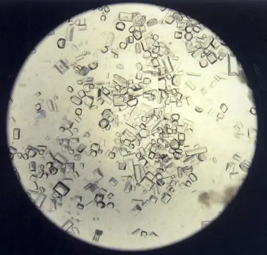 犬尿沉渣中的磷酸铵镁结晶