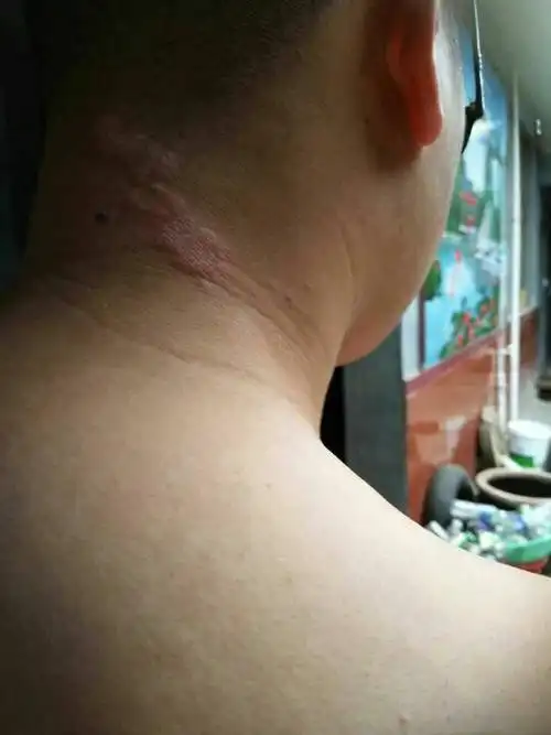 脖子后面刚开始起白皮 现在开始红肿 这是牛皮癣吗