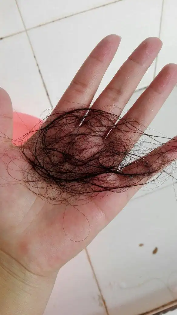 一洗头就掉头发,这样算正常掉发量吗?