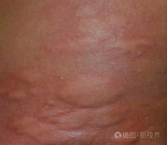 过敏皮肤背部和两侧.皮肤红肿红肿的过敏反应