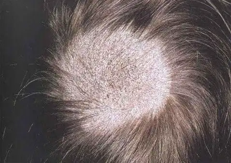 头上长癣轻度头皮癣症状早期真实图片-中华银屑病网