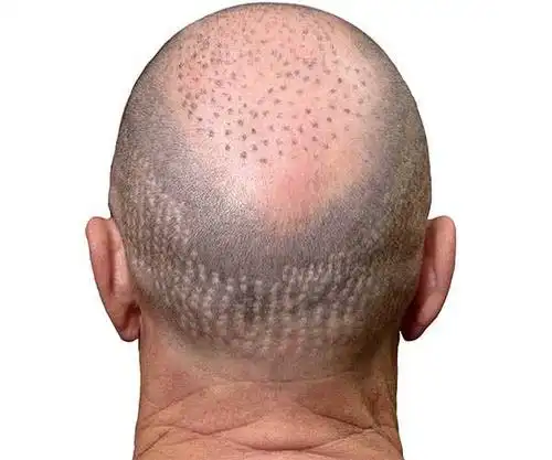 smp纹发失败之靠谱大揭秘:远期形态不可控,切勿懵懂被练手!