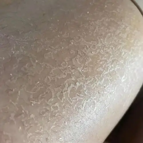 吸脂术后19天已经可以正常生活了腿子看起来细了好多