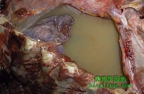 图示乳糜胸,右胸膜腔充满黄褐色云絮状液体.