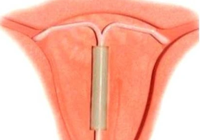 节育环给身体带来的副作用 带节育环会怀孕吗