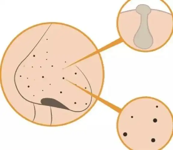 男人一生除了有聊不完的骚还有祛不完的黑头