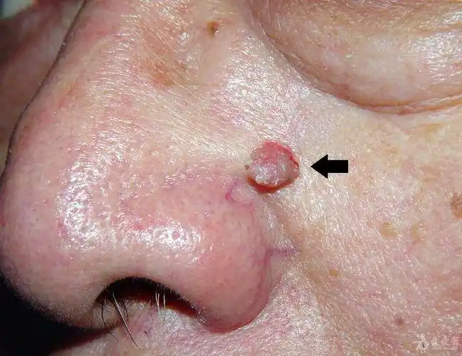 皮肤性病图谱☆有☆奖☆点☆评☆13:各个部位寻常疣.