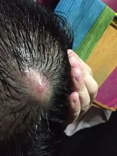 脑袋上起了一个包 之前还有个 慢慢的就下去了 这个好长时间不下去 还