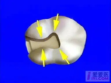 龋齿二类洞精典图片
