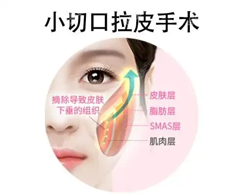 小切口拉皮手术