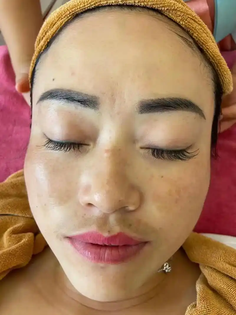 百分之百苹果原相机拍摄,祛斑前后对比,祛斑美白嫩肤成功,你们 - 抖音