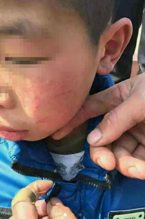 季某某(12岁)家住灌南县北陈集镇大有村,网友发布的照片显示其腿部