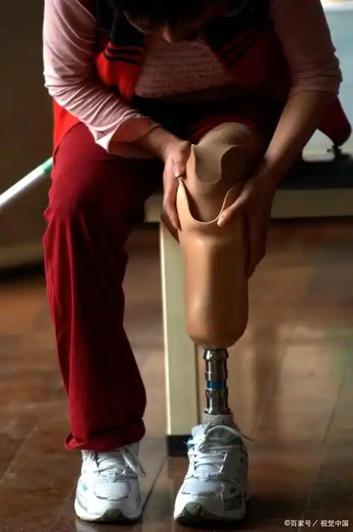 当需要佩戴假肢的话,价格会很贵吗?