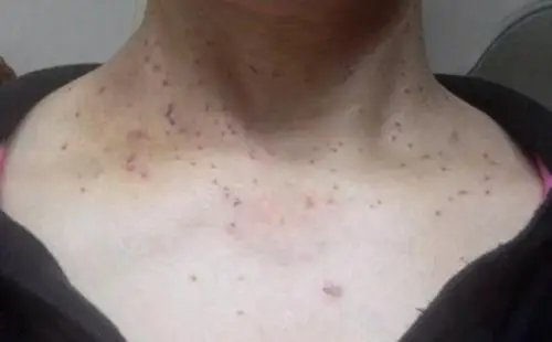 皮肤病扁平疣的图片