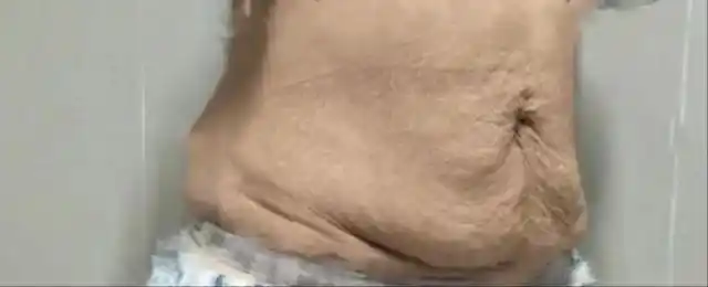 腹壁成形术是一种针对腹部的整形方式,解决腹壁皮肤松弛和脂肪堆积的