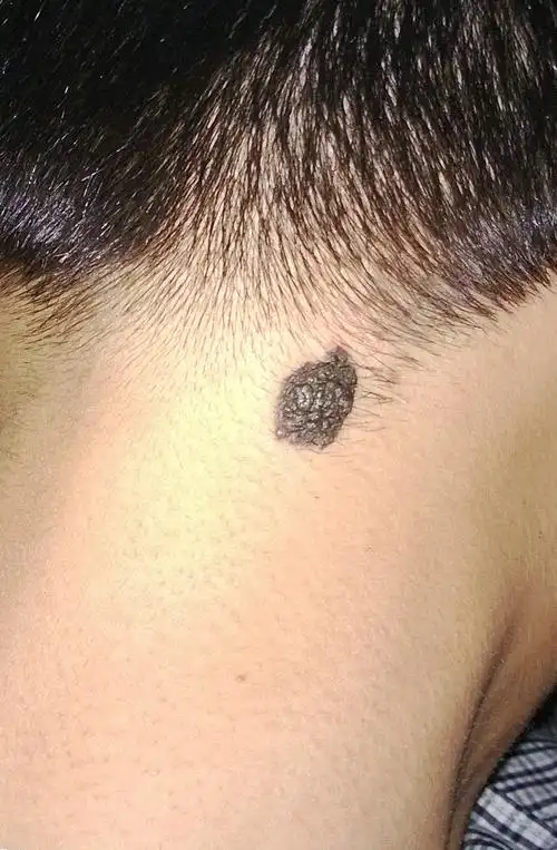 脖子后面有有大块黑痣,是不是黑色素瘤啊,可以激光去除吗