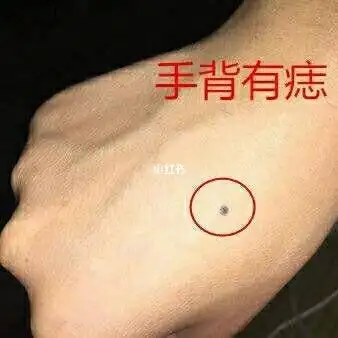 有痣图解大全男人右手手背痣各个位置图解女人手背有痣全图解手背痣图