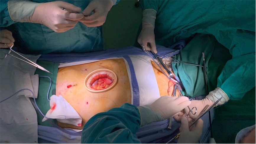 腹部正中小切口制作管状胃,食管胃左颈部端侧吻合(eea圆形吻合器)术后