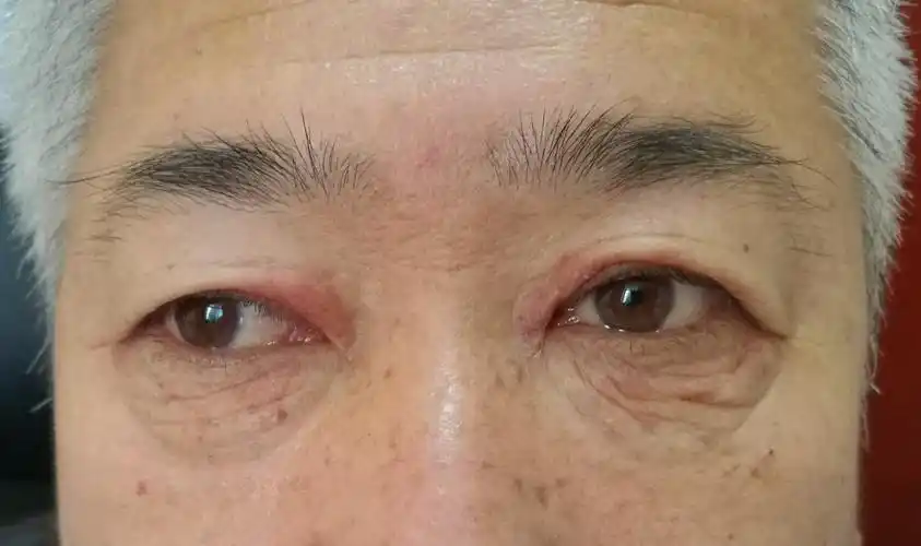 改变明显)图53关节肿图54足踝肿图55关节炎变形图56尿酸石图57(1)(2)