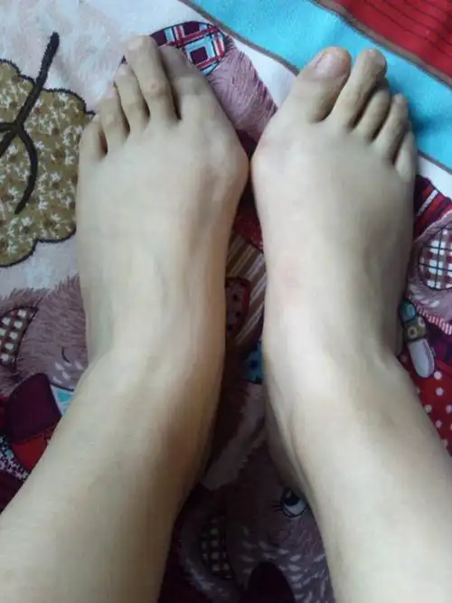 双脚拇外翻病人脚部图片
