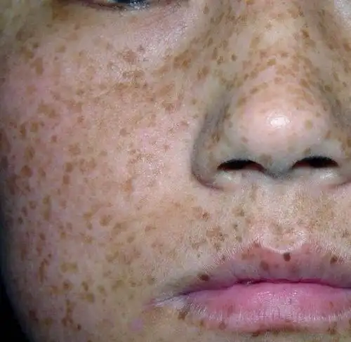 斑点太多成麻子脸,可能是黑色素疯狂繁殖,试试古时1种淡斑粉