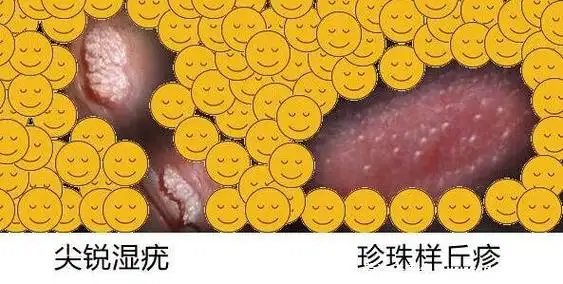 菜花状疣的早期,是像图片中的这个样子,在生殖器部位附近出现淡红色