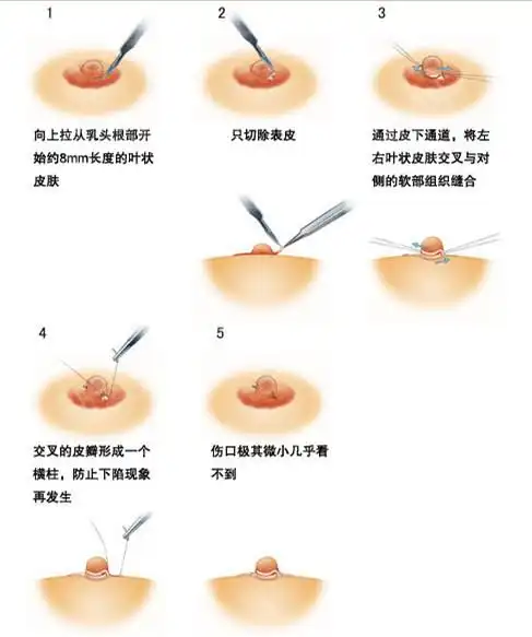 乳头内陷的妹纸可一定要重视起来啊,早晚都得手术,不如提前手术哦!