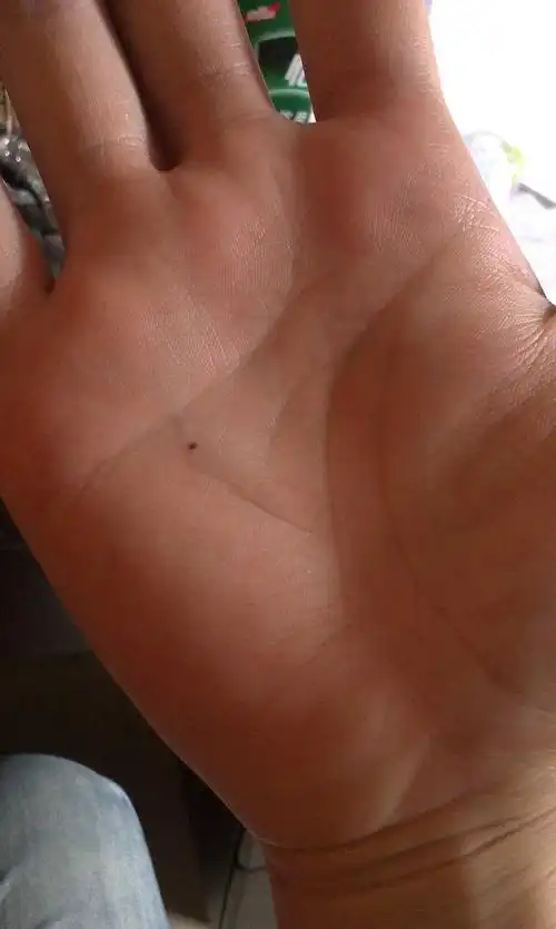 男的22岁右手手掌心突然(以前没有,不知道什么时候长的)长了一颗痣是