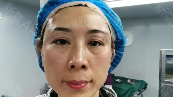 自体脂肪填充丰眼窝当天眼睛有点轻微的肿胀感眼部肌肤变得饱满紧致