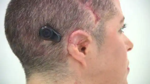 报道,近日,英国一名天生没有耳朵的女子在安装了一个高科技助听器后