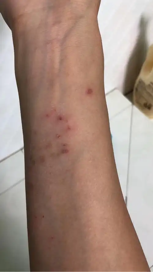 每年夏天都上都会长汗疱疹,吃过一副中药调理好了好几年.