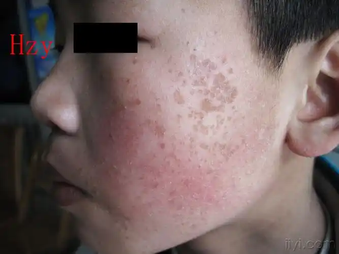 脸部谁能看出他患的是哪两种皮肤病.公布答案:1,扁平疣 .2,鱼鳞病.