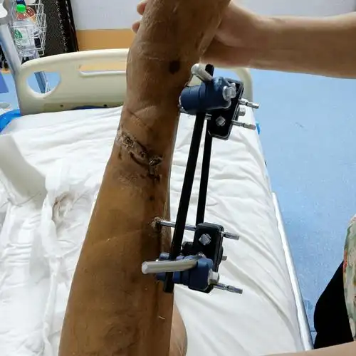 小腿完全断裂,博白医生展开8小时惊心动魄救援!