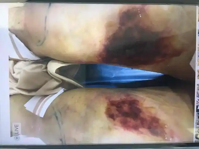 很明显,抽脂区域已经感染并呈现坏死性筋膜炎的外观了.