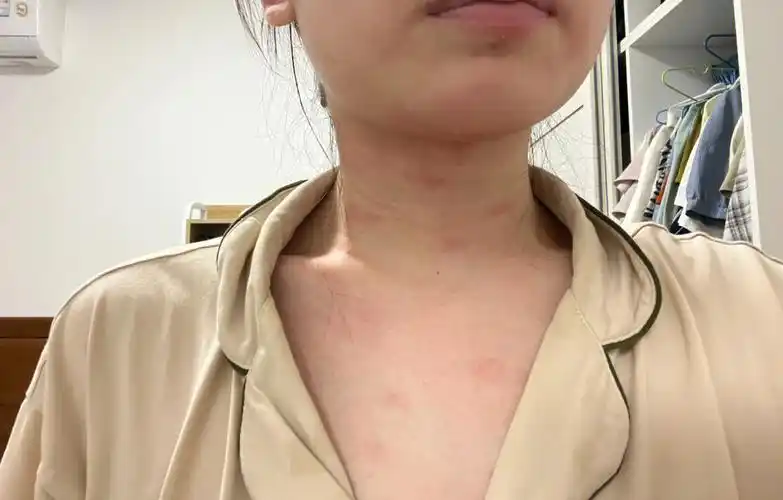 不知道什么原因过敏了,全脸像长痱子一样,身上一个一个小红点巨痒!