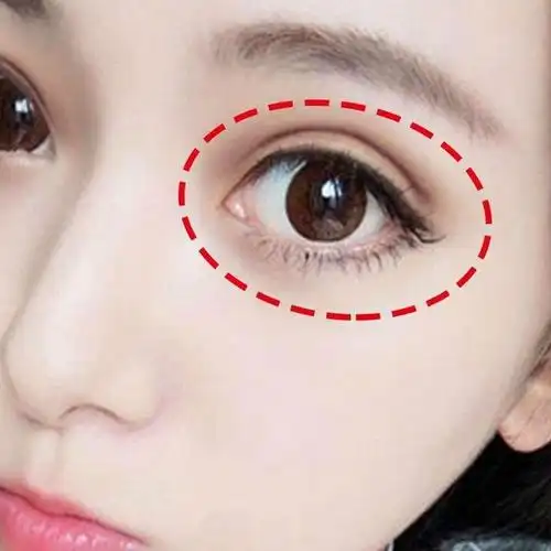 欧式双眼皮