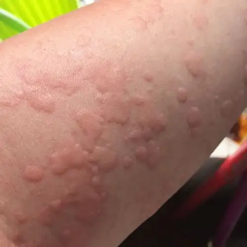 突然全身在这些东西,是过敏吗?应该用什么药