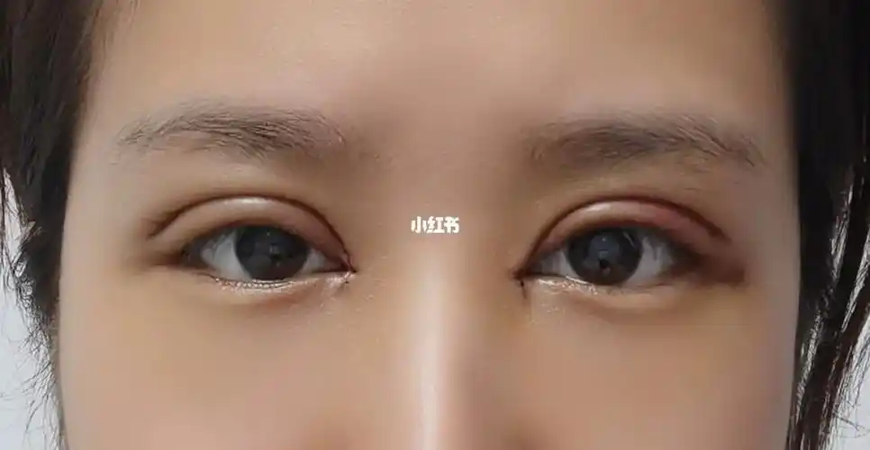 双眼皮手术第四天