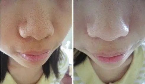 怎么收缩毛孔粗大 网友的意见