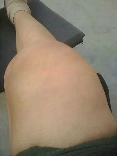 诊断结果是左腿急性滑膜炎 膝盖积液躺在床上18天了还没有消要不要