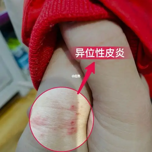 过敏性湿疹,异位性皮炎怎么办?_湿疹_皮炎_荨麻疹_过敏体质_皮肤问题_