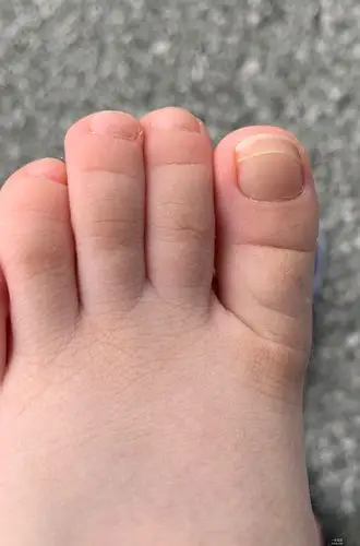 求助小朋友2个大脚趾指甲都有横向的裂纹是怎么回事