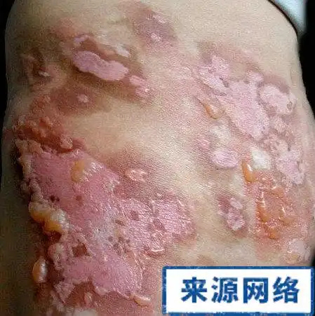 皮疹症状 艾滋病皮疹图片