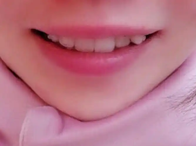 对自己的虎牙一直不是很满意,而且有点牙齿不齐,就到_圈子-新氧美容